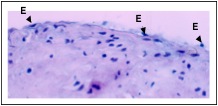 Endoarterial biopsy during "early rejection" showing minimal reactive endothelial cell (E) changes, with rounded, plump nuclei.