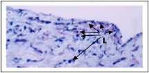 Subendothelial and medial inflammation consistent with "late rejection." Numerous lymphocytes (L) are present immediately under the endothelium and within the smooth muscle layer.